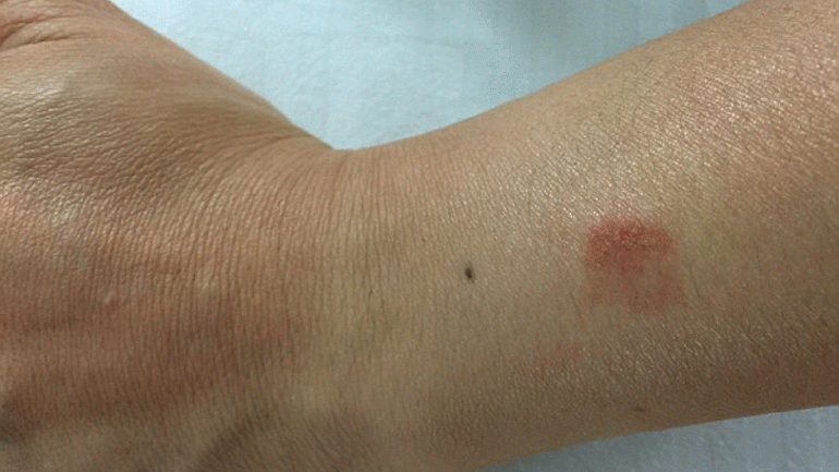 El Apple Watch, ¿quema?
