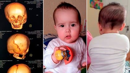 La beba de 8 meses que necesitaba dinero para una cirugía de cráneo fue operada con éxito