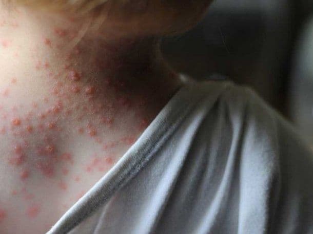 Viruela del mono: qué significa que la OMS decretara la emergencia internacional