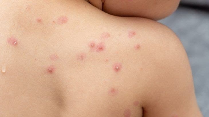 Viruela del mono en Argentina: ya hay 24 casos confirmados en el país