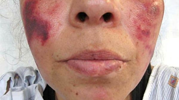 Alerta cocaína: una sustancia de corte “pudre” la carne de los adictos y está en Argentina
