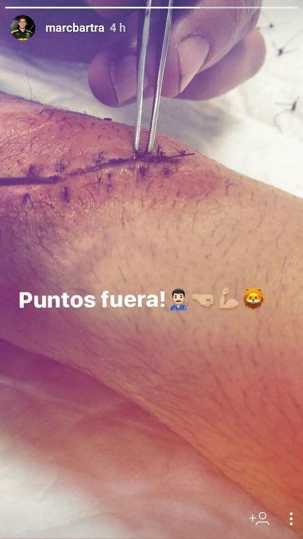 Marc Bartra mostró la escalofriante herida que le produjo el ataque al bus del Borussia Dortmund