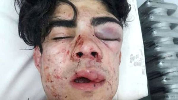 Golpearon a un joven hasta desfigurarlo porque creyeron que era chileno