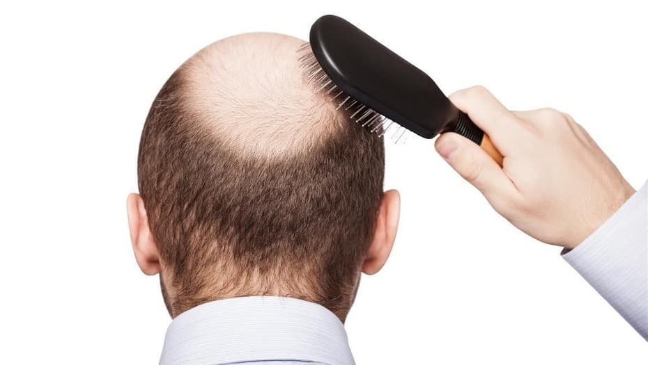 ¿Encontraron la cura para la pérdida de pelo?