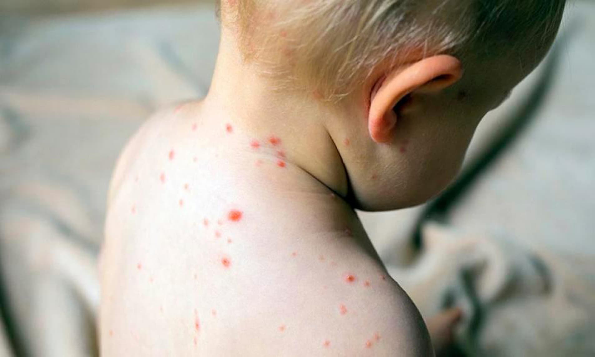 Salud afirma que «no faltaron ni faltarán» dosis de vacunas contra el sarampión