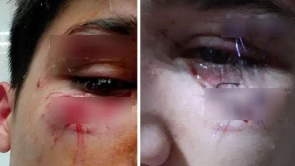 Rugbier desfiguró a trompadas a pibe que lo empujó sin querer en un boliche